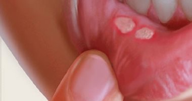 قرح الفم.. أسبابها وسر علاجها فى هذا المسحوق قرح الفم.. أسبابها وسر علاجها فى هذا المسحوق